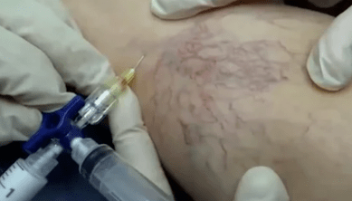 varisli damarlar için skleroterapi