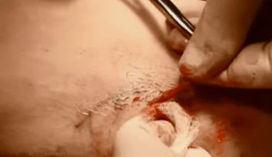 varisli damarları çıkarmak için operasyon türleri